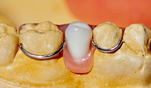 Load image into Gallery viewer, Acrylic Partial Denture, Flipper, Includes 1 Tooth, Save $37 with promotional code:TCG15

