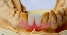 Load image into Gallery viewer, 2 teeth flexible partial denture
