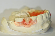 Load image into Gallery viewer, Flexible Partial Denture, Includes 1 tooth, Save $52 with promotional code:TCG15
