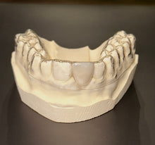 Load image into Gallery viewer, CLEAR RETAINER PARTIAL DENTURE
