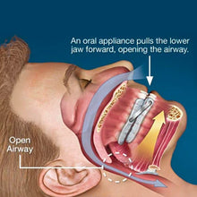 Load image into Gallery viewer, Silent Nite sleep apnea device. Helps stop snoring while you sleep. www.theclearguard.com
