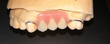 Load image into Gallery viewer, Acrylic Partial Denture, Flipper, Includes 1 Tooth, Save $37 with promotional code:TCG15
