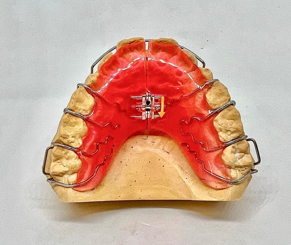 Tips For Cleaning A Hawley Retainer – The Clear Guard