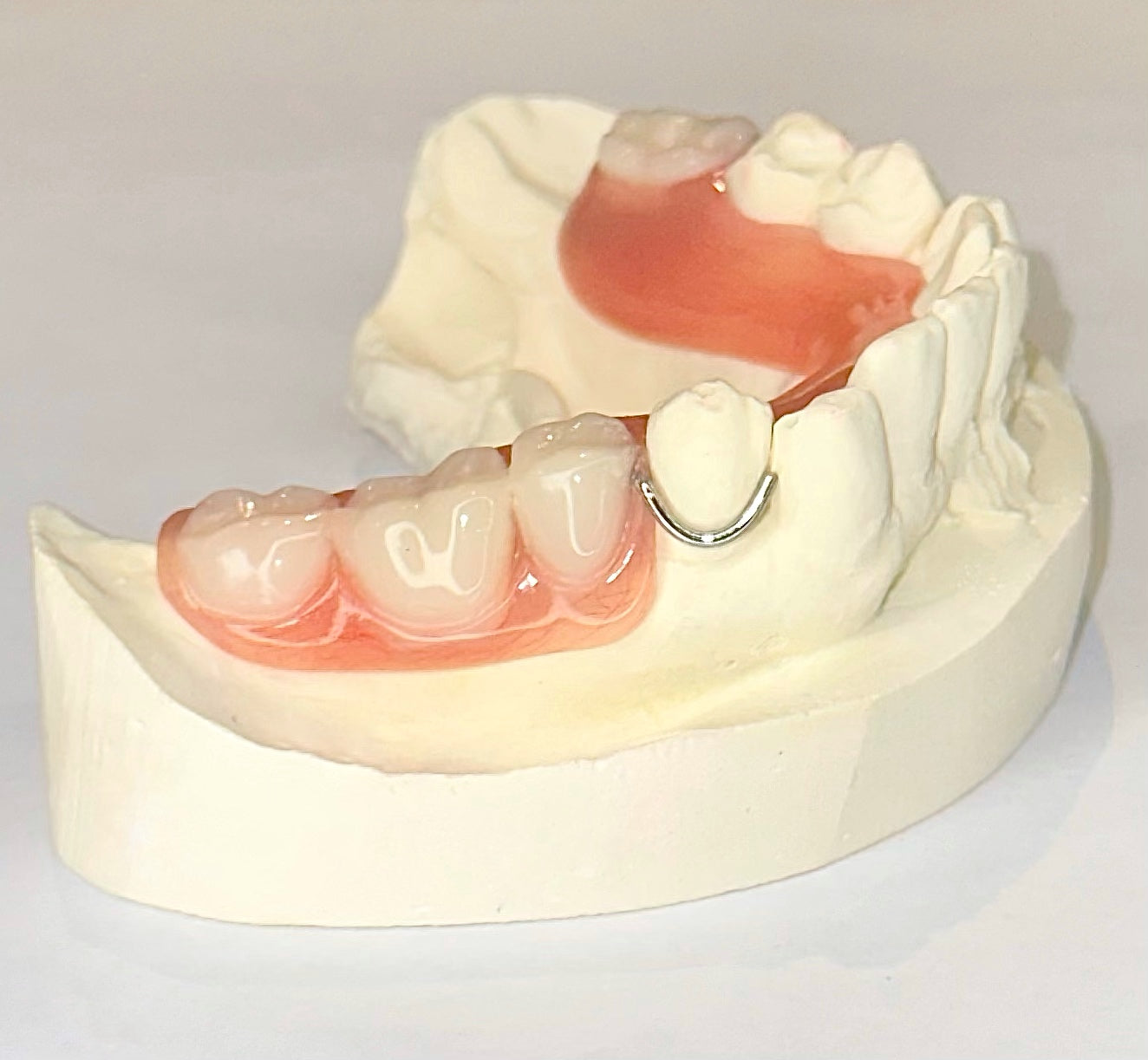 Lower Partial Dentures