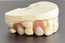 Load image into Gallery viewer, Acrylic Partial Denture, Includes 1 Tooth, Save $45*** Use code:TCG15 at checkout
