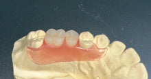 Load image into Gallery viewer, Flexible Partial Denture, Includes 1 tooth, Save $52 **** Use Code:TCG15 at checkout
