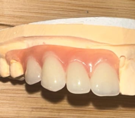 3 Teeth Add OnTo Make A Total Of 4 Tooth Partial Denture